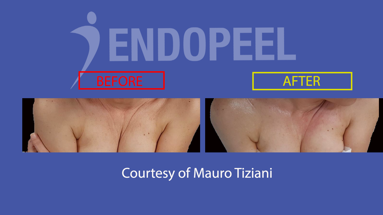 decollete skin wrinkles